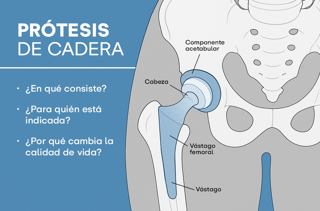 Prótesis de cadera: en qué consiste, para quién está indicada y por qué cambia la calidad de vida