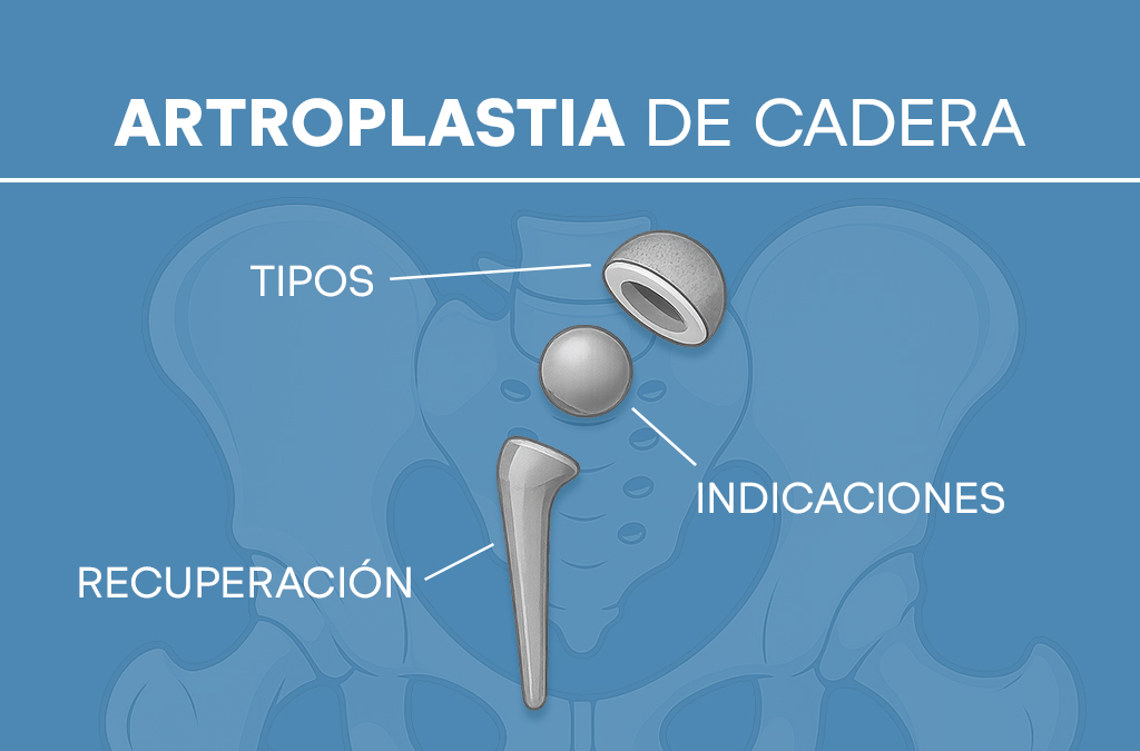Artroplastia de cadera: tipos, para quién es cada uno y cómo logramos una recuperación excelente