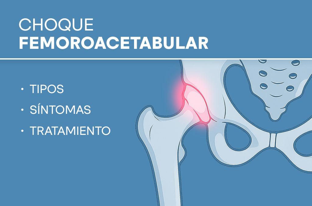 Choque femoroacetabular (FAI): qué es, cómo detectarlo y cómo volver al deporte sin dolor